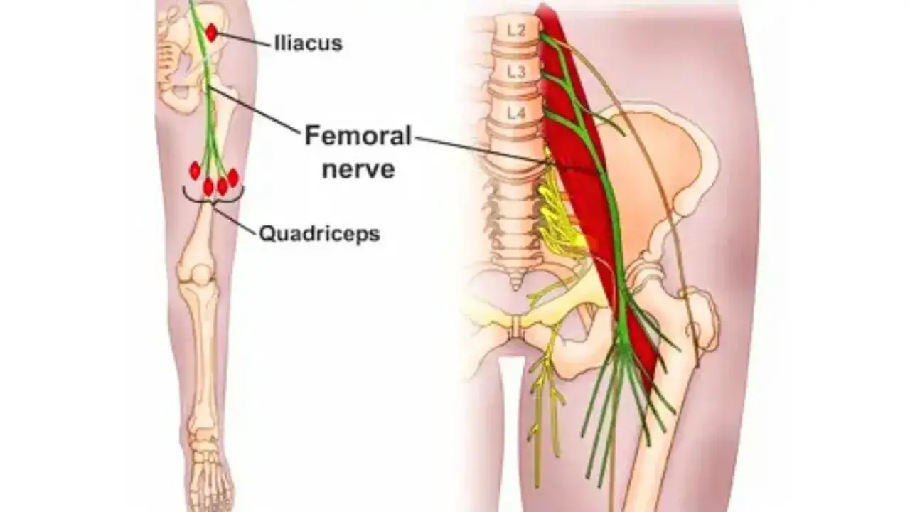 Illustrazione anatomica del nervo femorale e dei muscoli dell'anca e della coscia. Una possibile causa di lombo cruralgia.