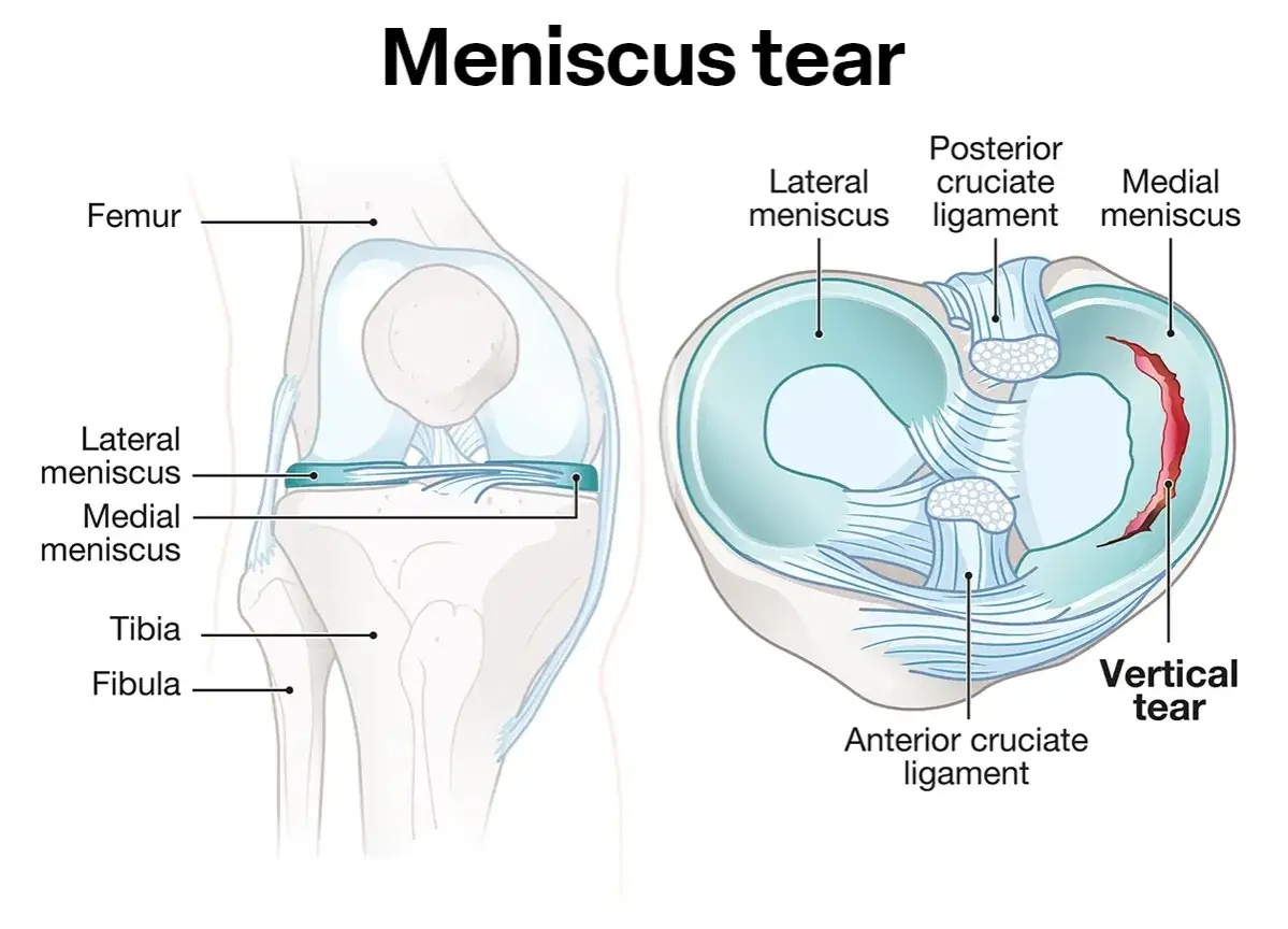 Dettaglio anatomico del ginocchio che illustra una lesione verticale del corno posteriore del menisco mediale.