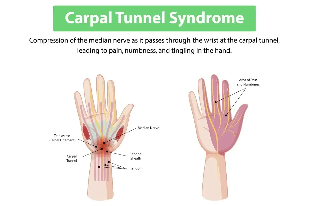 Illustrazione del tunnel carpale che causa dolore polso e mano. Mostra la compressione del nervo mediano e l'area interessata da dolore e intorpidimento.