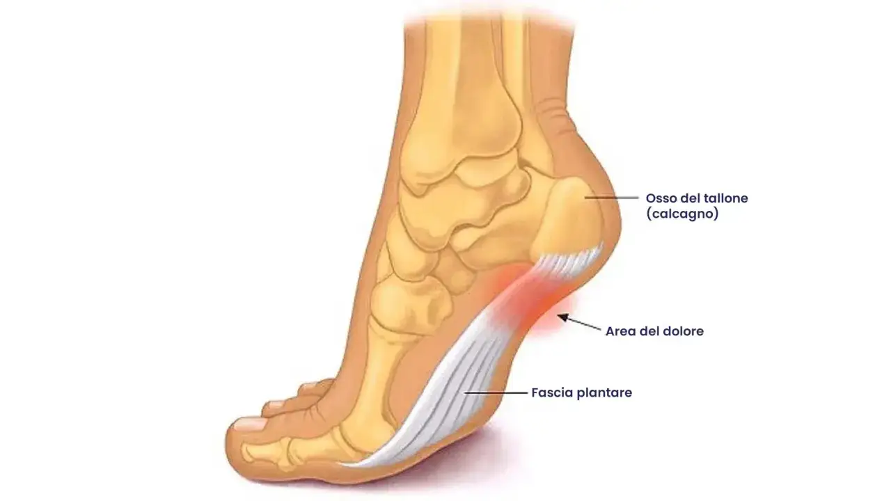 Illustrazione anatomica del piede che mostra l'osso del tallone e la fascia plantare, con un'area rossa che indica il dolore.