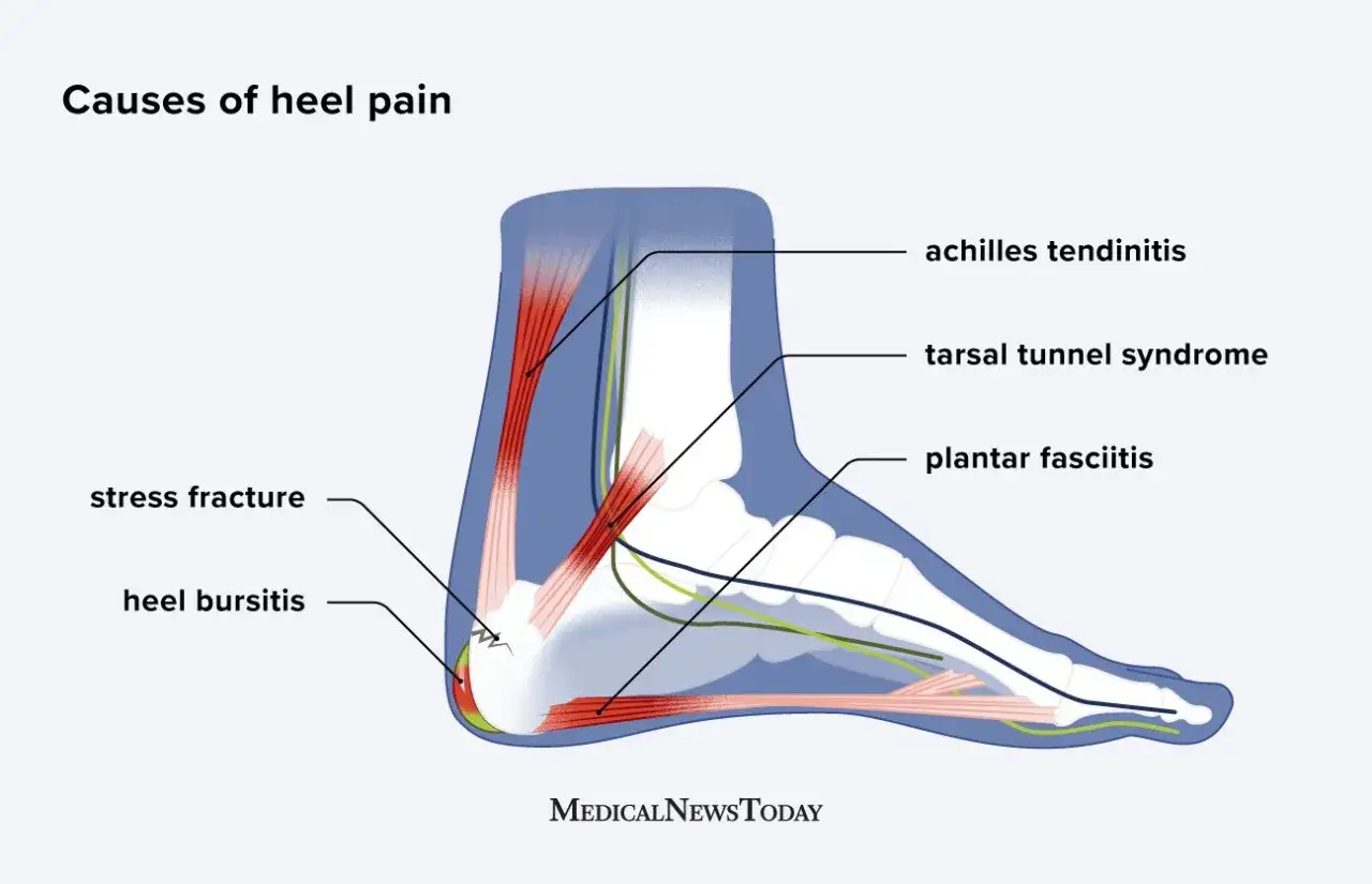 Anatomia del piede che illustra le cause del dolore al tallone come spilli: tendinite achillea, sindrome del tunnel tarsale, fascite plantare, frattura da stress e borsite.