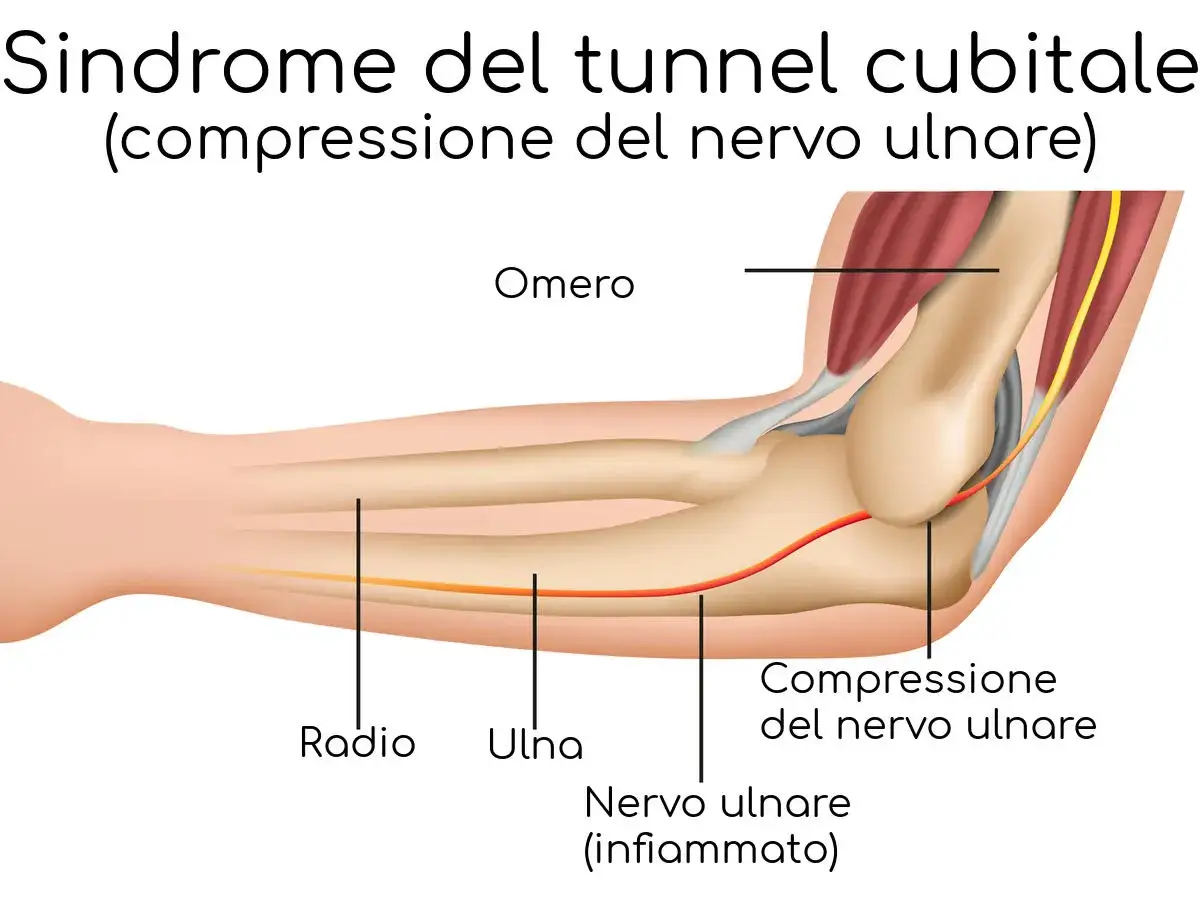 Illustrazione anatomica del gomito che mostra la compressione del nervo ulnare, causa di dolore al polso che si irradia al braccio.