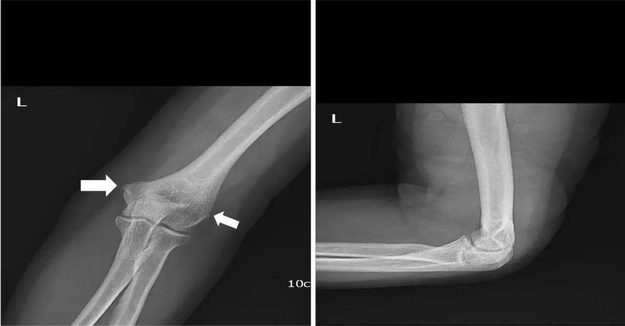 Radiografie del gomito sinistro mostrano calcificazione. Le frecce indicano aree di depositi calcifici.