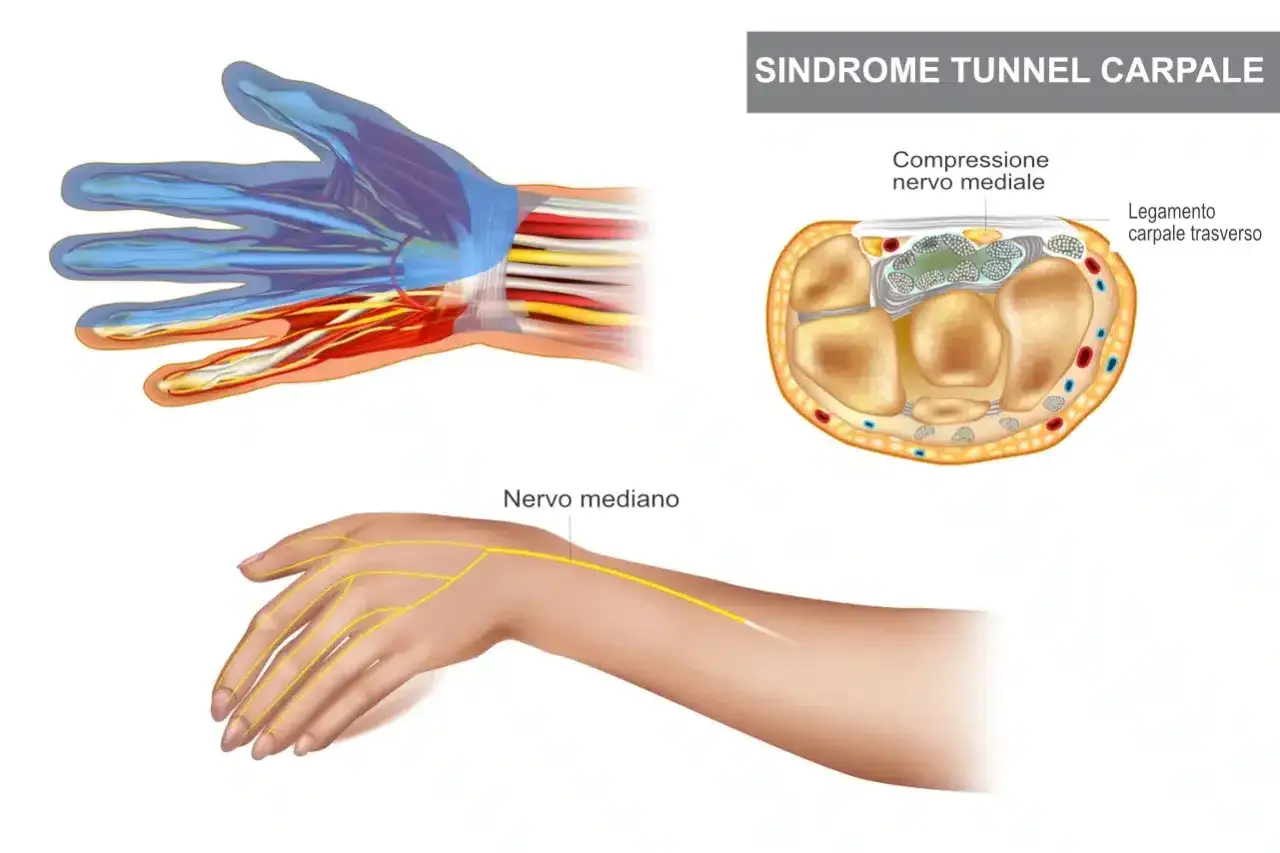 Illustrazione della sindrome del tunnel carpale: compressione del nervo mediano al polso, causa di dolore al polso senza trauma.
