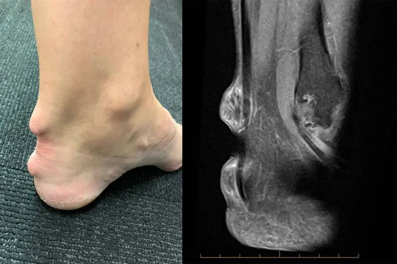 Piedi con gonfiore e deformit&agrave;, possibili sintomi iniziali di artrite reumatoide, confrontati con immagine RM.