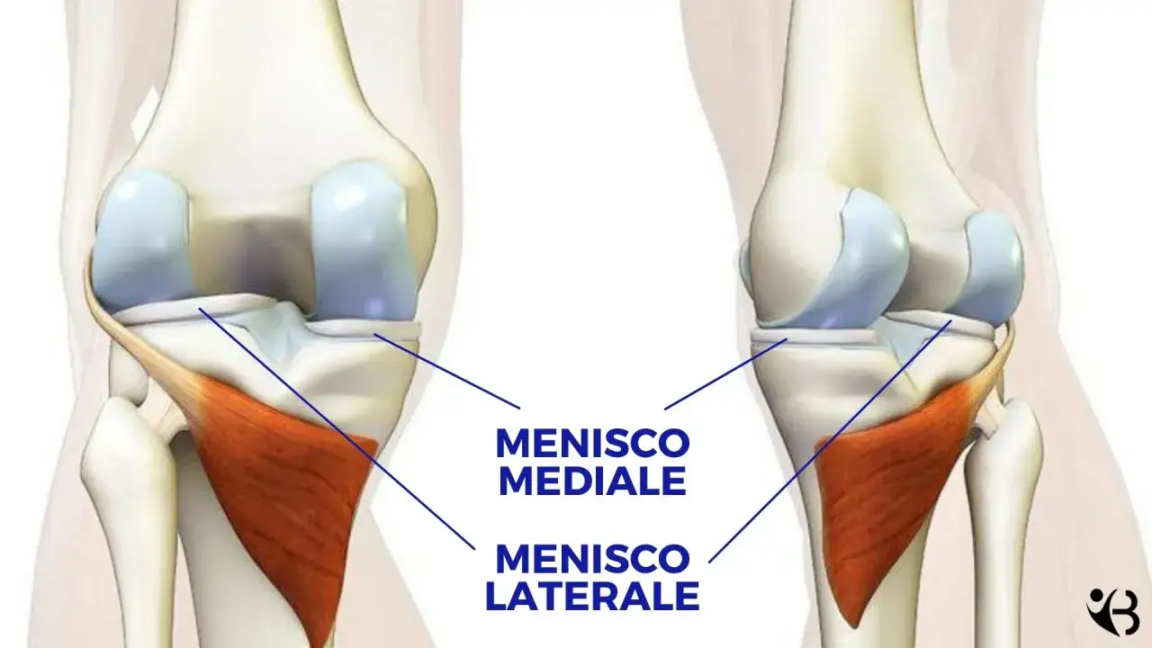 Anatomia del ginocchio: menisco mediale e laterale. Illustrazione mostra una lesione menisco senza gonfiore.