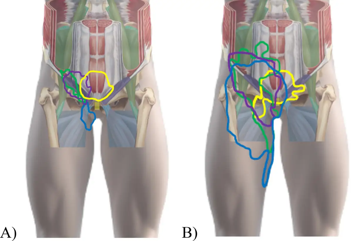 Diagrammi anatomici che illustrano aree di dolore all'attaccatura della gamba, con diverse zone colorate.