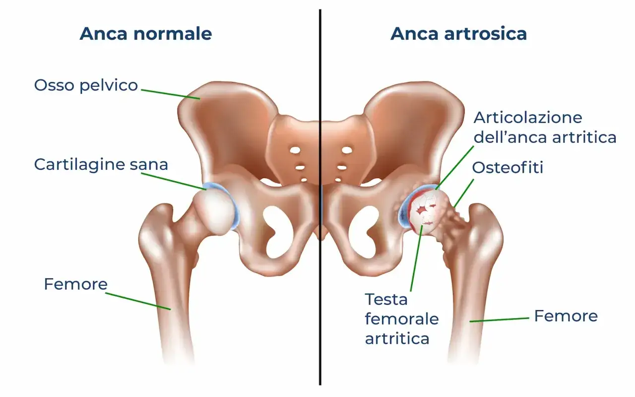 Confronto tra anca sana e anca artrosica, illustrando la coxalgia e i suoi effetti su cartilagine e femore.
