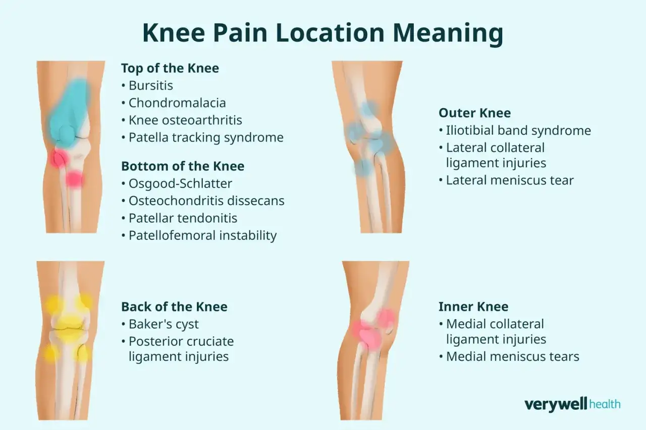Dolore al ginocchio laterale: cause comuni come sindrome della bandelletta ileotibiale, lesioni legamento collaterale laterale, lesioni menisco laterale.