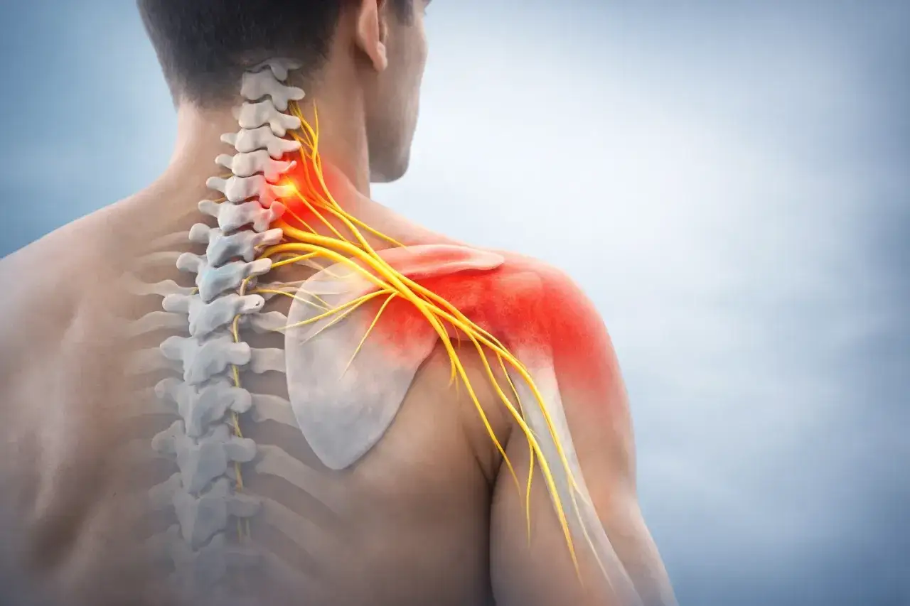 Illustrazione anatomica che mostra il dolore muscolo collo spalla, con nervi evidenziati in giallo e aree rosse di infiammazione.