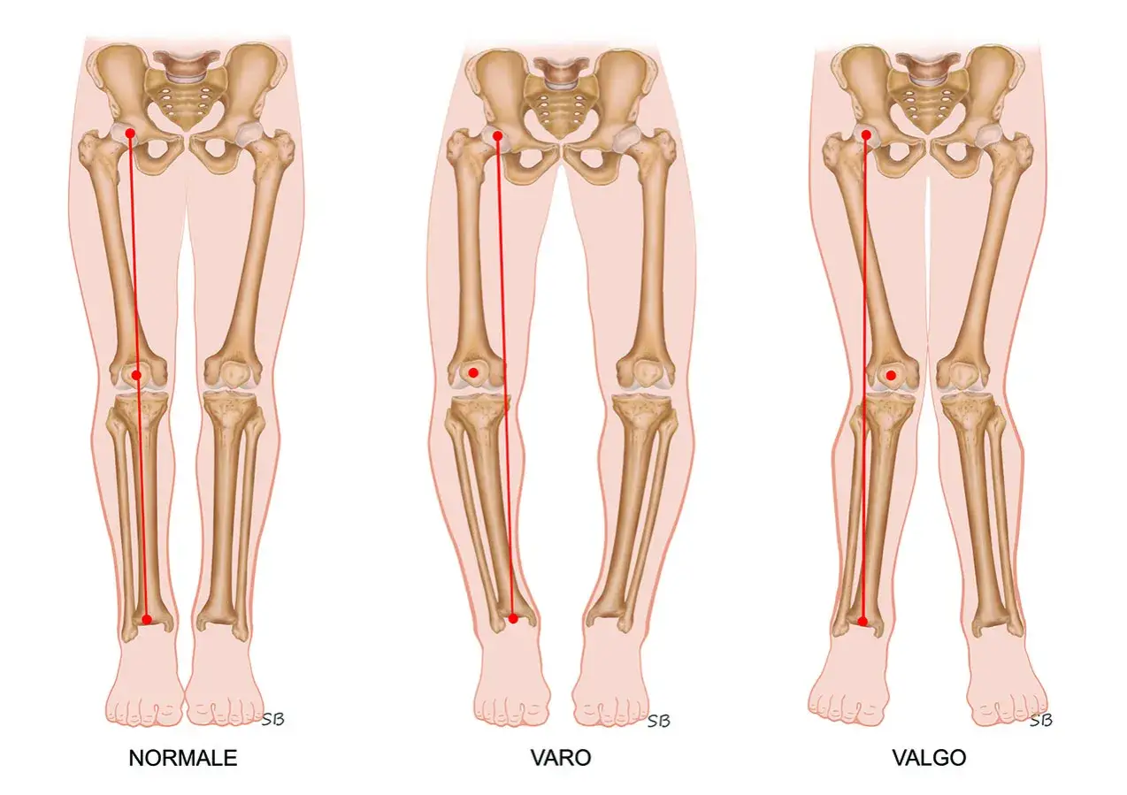 Illustrazione scheletrica delle gambe: normale, varismo (ginocchia a O) e valgismo (ginocchia a X).