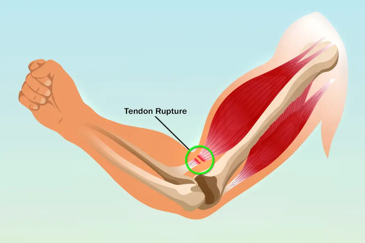 Illustrazione anatomica di una lesione tendinea al braccio. Cosa fare in caso di lesione tendinea al braccio.