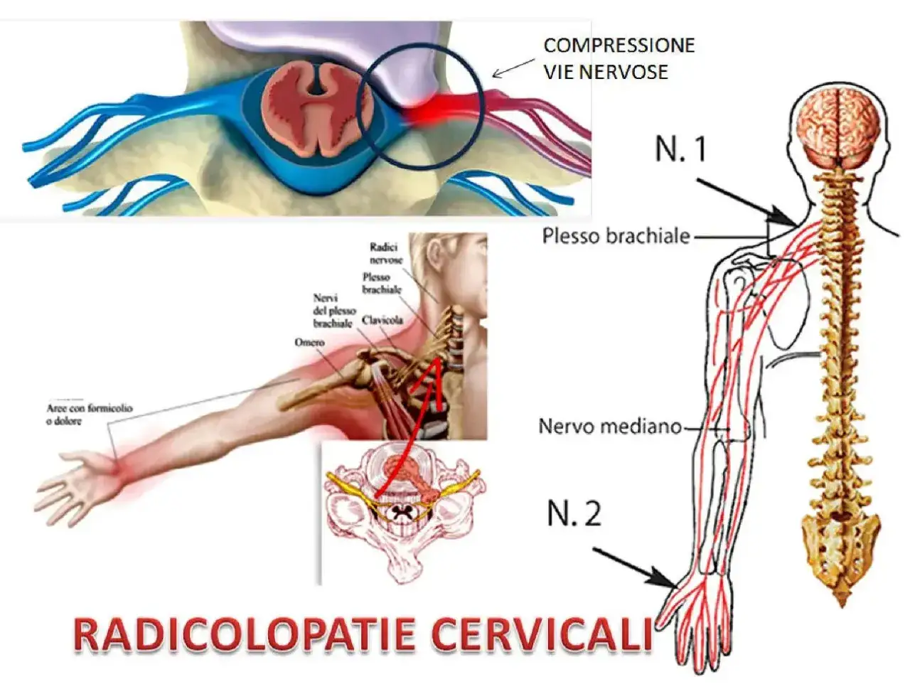 Illustrazione mostra dove si trova la cervicale e la compressione delle vie nervose, con dettagli sul plesso brachiale e sul nervo mediano.