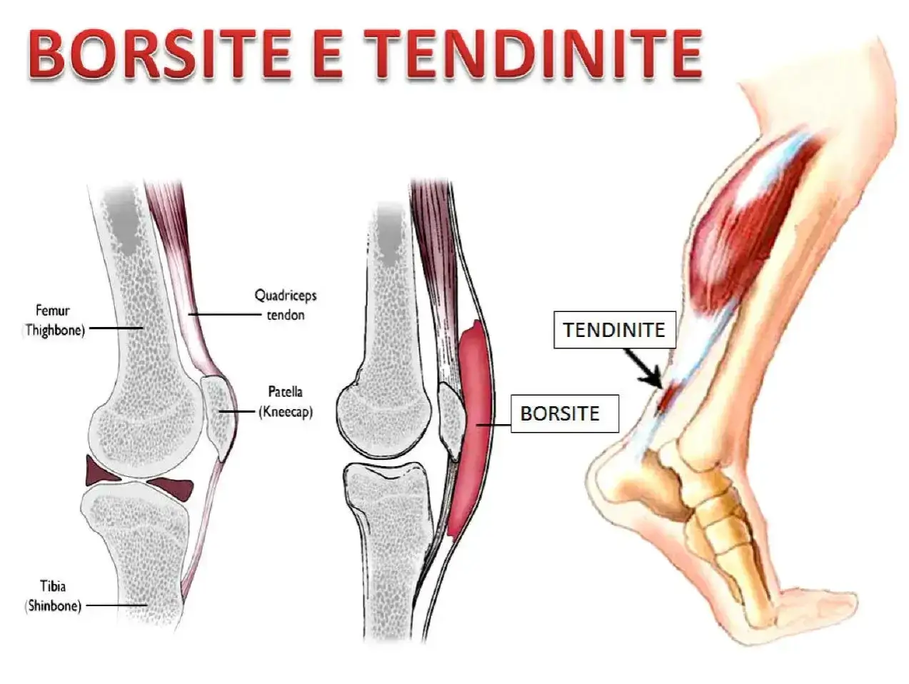 Illustrazione anatomica che mostra borsite e tendinite. La borsite malleolo è evidenziata vicino al tendine d'Achille.