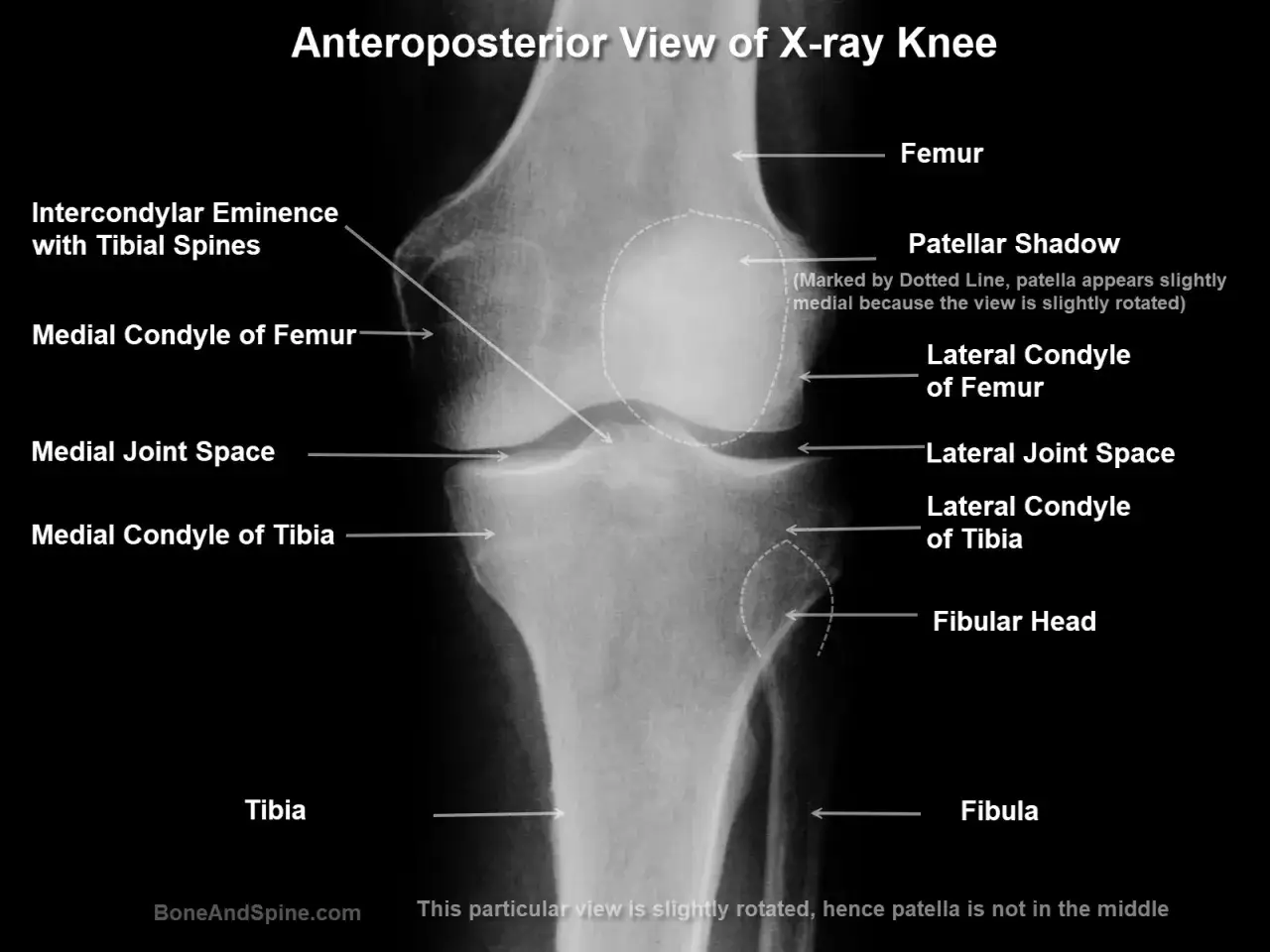 Radiografia anteroposteriore del ginocchio. Si osservano femore, tibia, rotula e fibula. La gonartrosi femoro rotulea può interessare queste articolazioni.