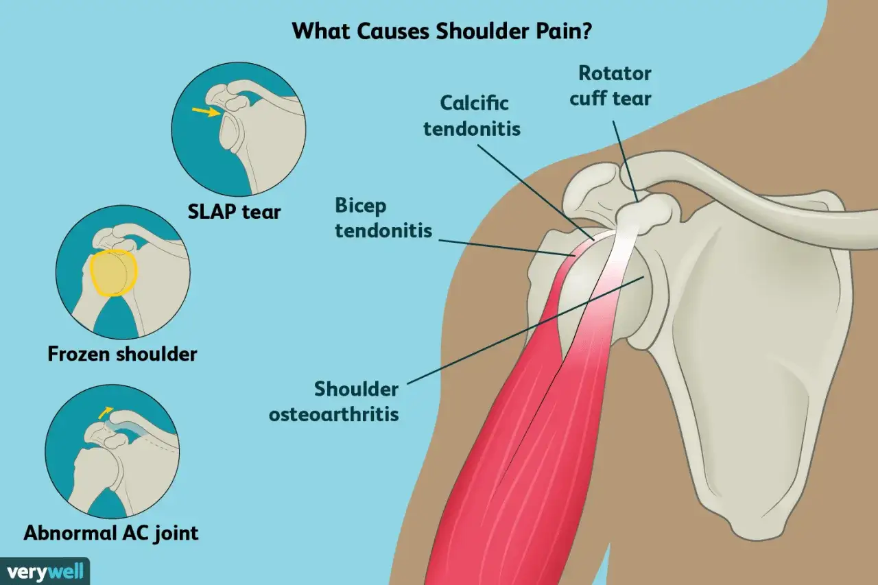 Illustrazione anatomica della spalla che mostra le cause del dolore, inclusa la tendinite del bicipite.