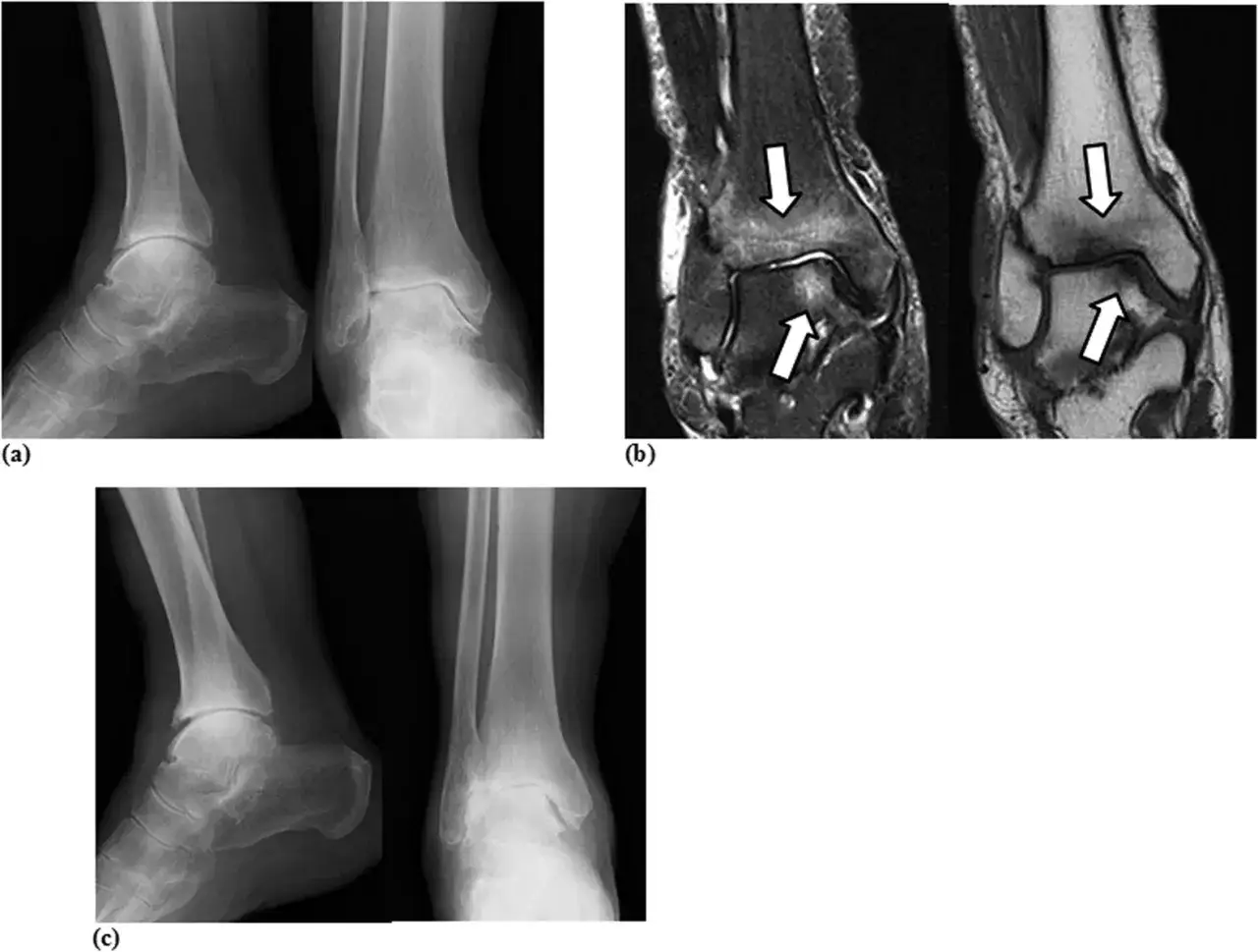 Radiografie e risonanze magnetiche mostrano segni di artrosi caviglia, con alterazioni ossee e cartilaginee evidenziate da frecce.