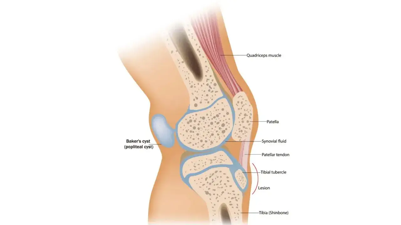 Anatomia del ginocchio con cisti di Baker. Illustra la posizione della cisti e il liquido sinoviale, utile per capire i cisti di Baker tempi di guarigione.