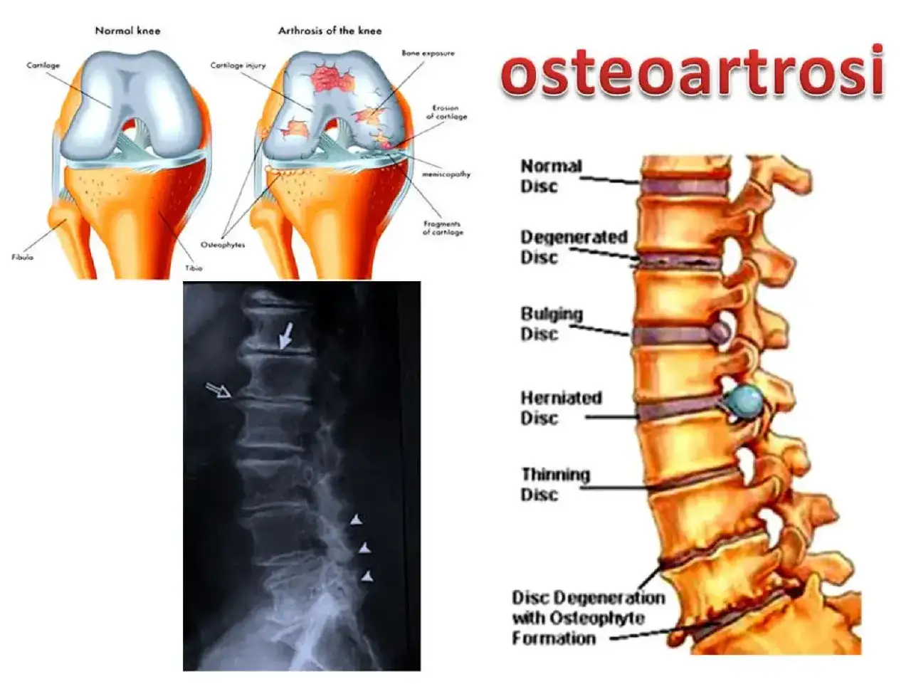 Illustrazione di ginocchio sano e artrosico, colonna vertebrale con dischi degenerati e radiografia lombare, che mostrano l'artrosi interapofisaria.