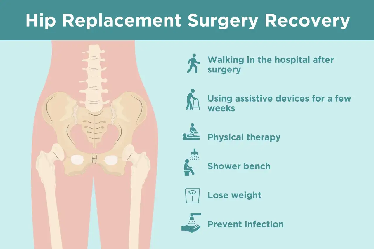 Recupero post-operatorio dell'anca: camminare, fisioterapia, perdita di peso e prevenzione infezioni. L'operazione all'anca quanto dura? Dipende dal recupero.