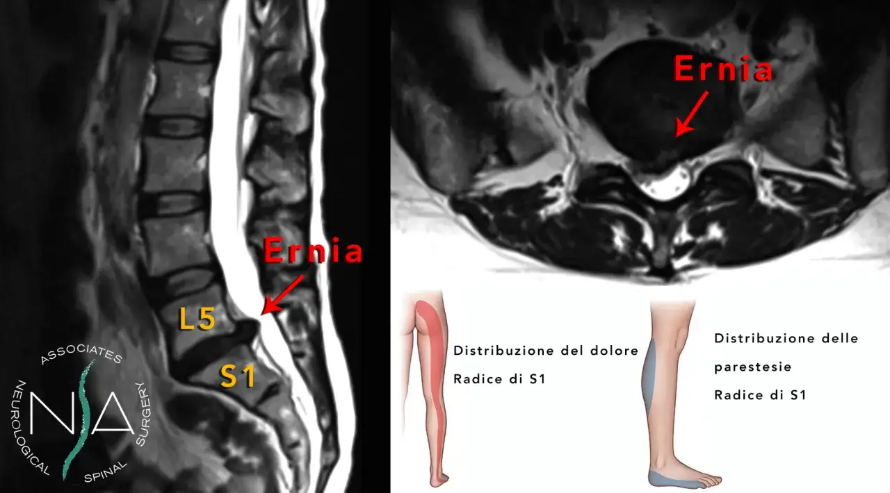Risonanza magnetica lombare mostra ernia discale L5-S1, causa di dolore al nervo sciatico. Illustrata distribuzione del dolore e parestesie.