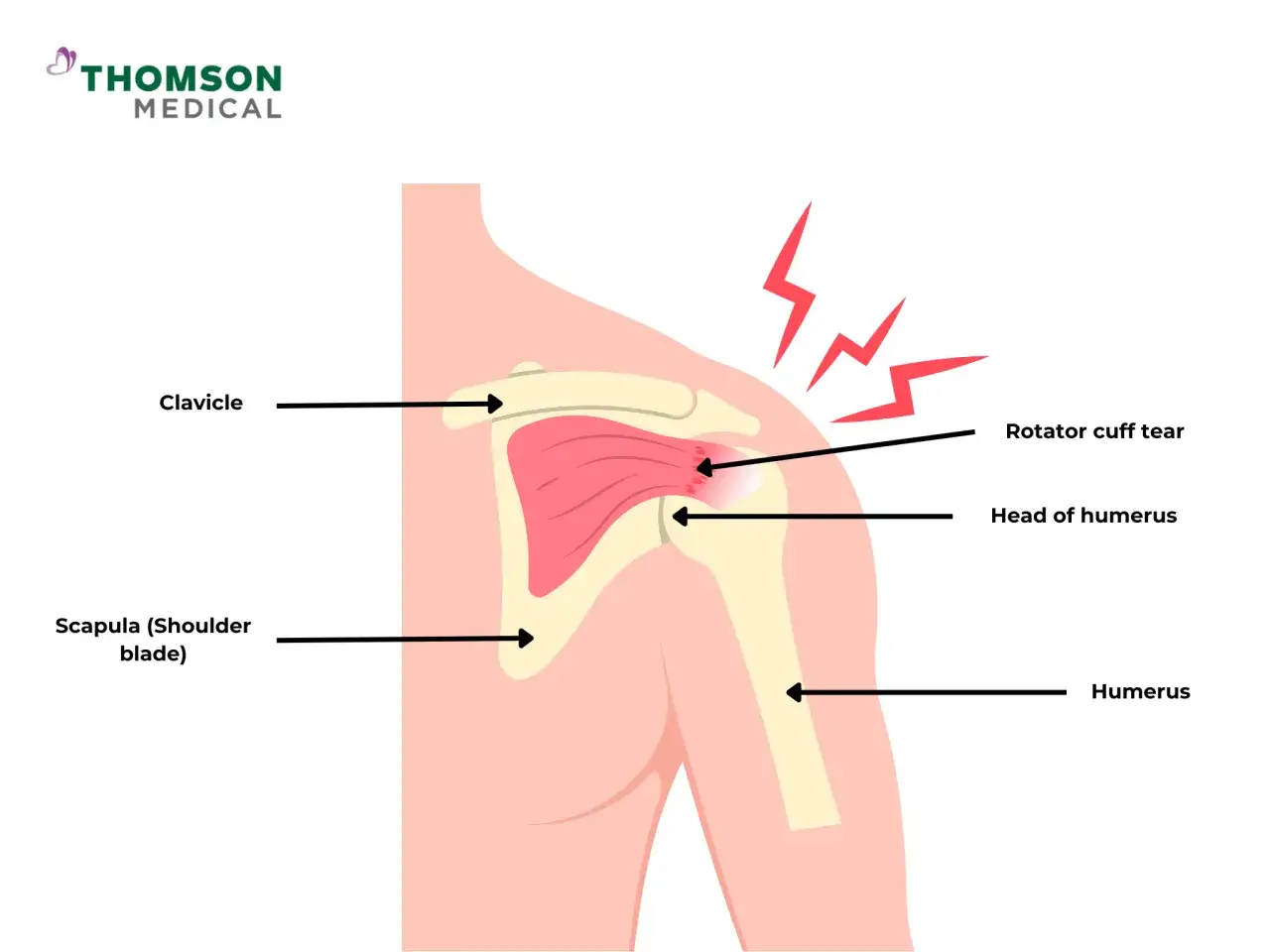 Spalla destra con dolore quando si alza il braccio, evidenziato da fulmini rossi. Illustrazione anatomica di una lesione della cuffia dei rotatori.