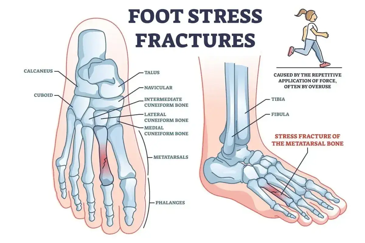 Illustrazione anatomica del piede che mostra una frattura da stress nel quinto metatarso, causata da sforzi ripetuti.