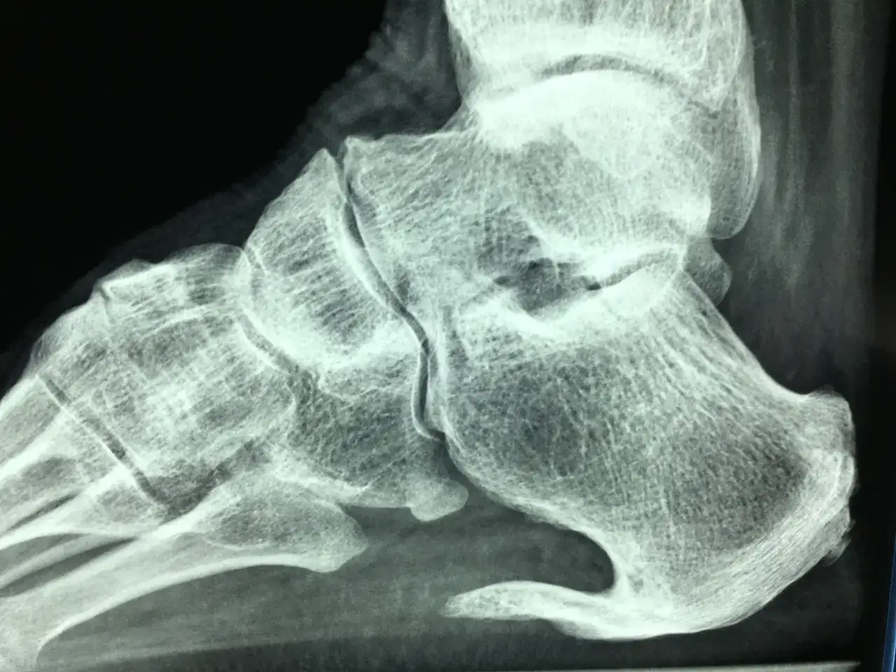 Radiografia del piede che mostra una spina calcaneare, una calcificazione ossea dolorosa sul tallone.