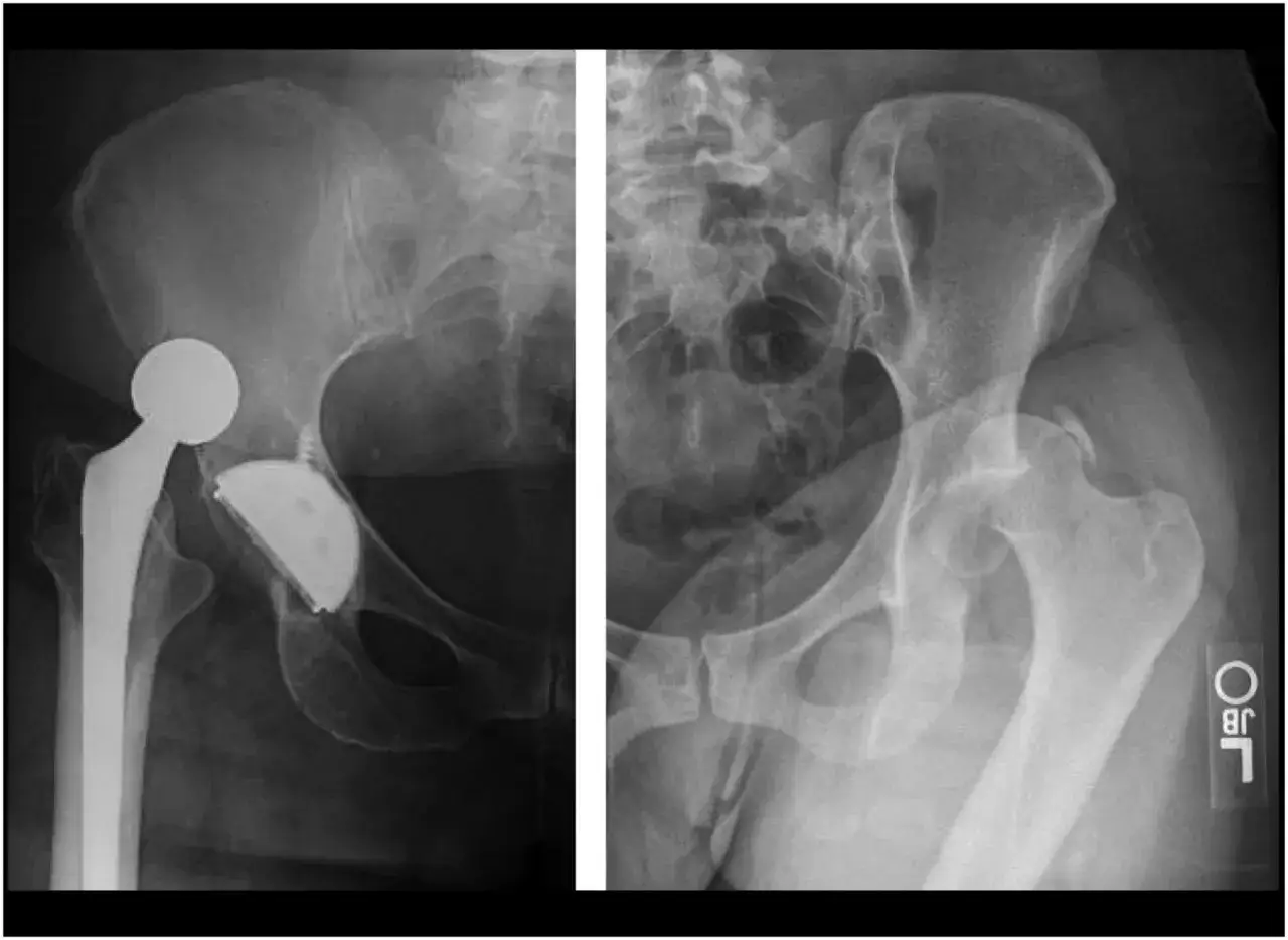 Radiografie dell'anca: a sinistra protesi totale, a destra anca sana. Utile per valutare i tempi di recupero dopo lussazione anca.