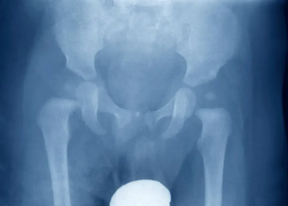Osteocondrosi dell’anca nei bambini - sintomi e cure
